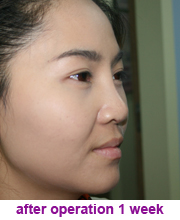 plastic_surgery_augmentation_rhinoplasty